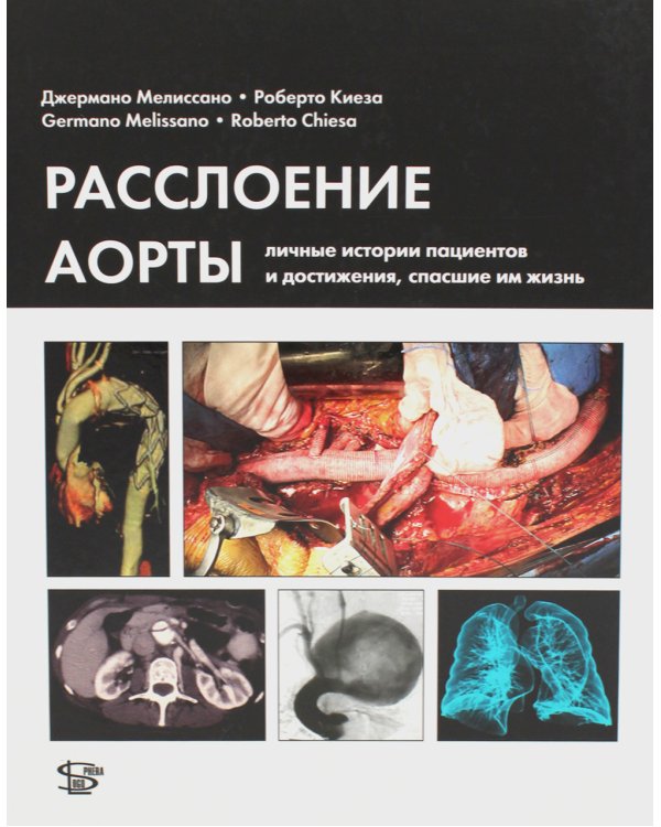 Расслоение аорты. Личные истории пациентов и достижения, спасшие им жизнь