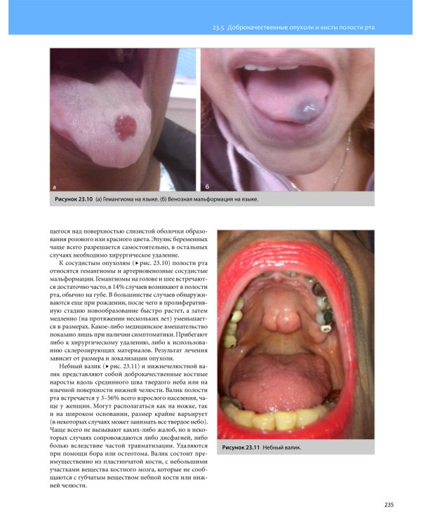 Общая оториноларингология - Хирургия головы и шеи. В 2 т