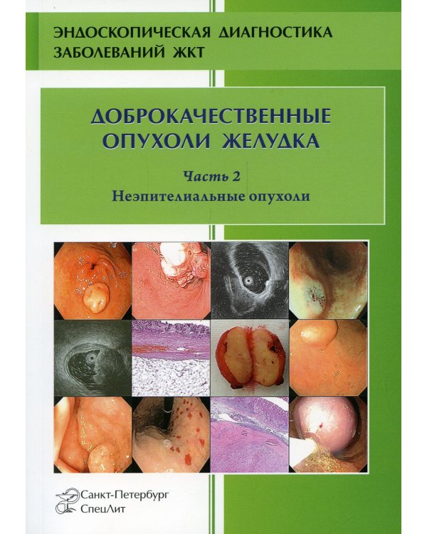 Доброкачественные опухоли желудка. Часть 2. Неэпителиальные опухоли