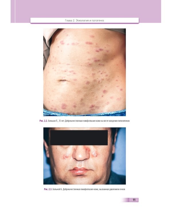 Доброкачественная лимфоплазия кожи: руководство для врачей