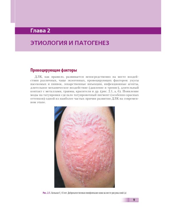 Доброкачественная лимфоплазия кожи: руководство для врачей