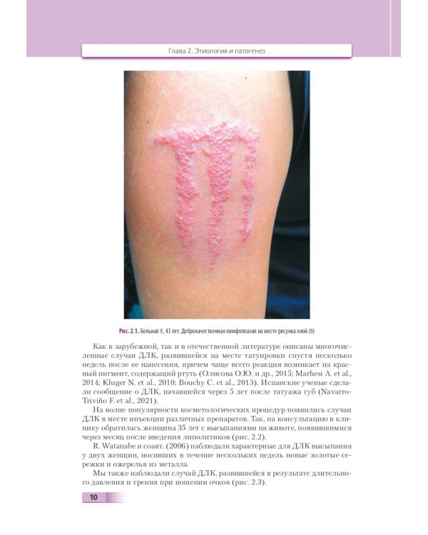 Доброкачественная лимфоплазия кожи: руководство для врачей