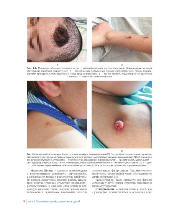 Пигментные и сосудистые новообразования кожи у детей. Атлас