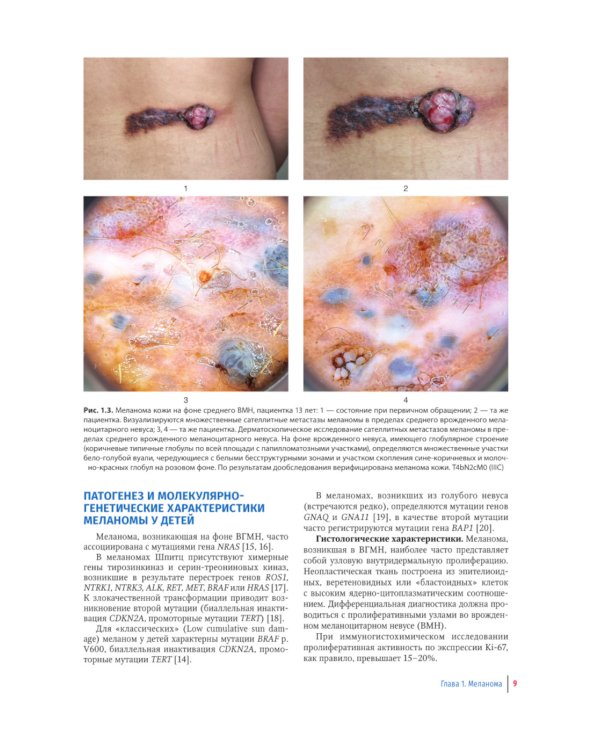 Пигментные и сосудистые новообразования кожи у детей. Атлас