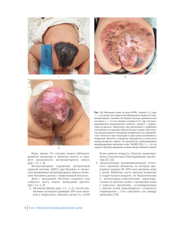 Пигментные и сосудистые новообразования кожи у детей. Атлас