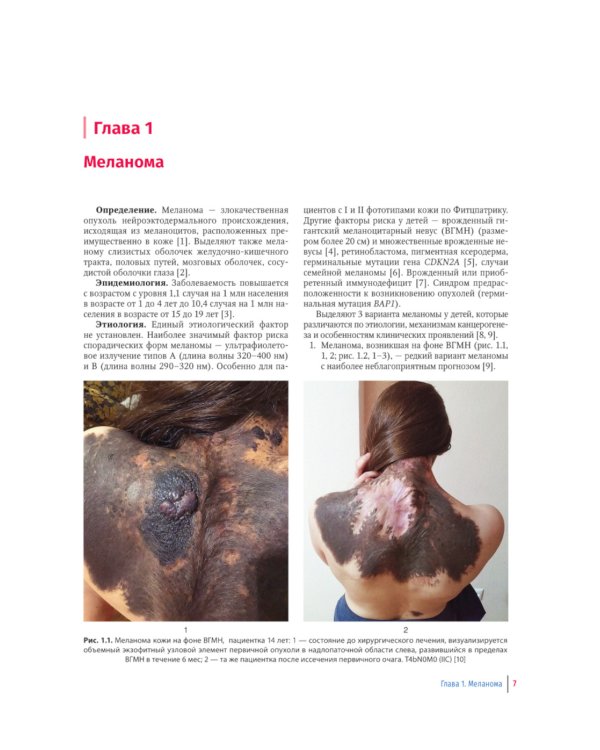 Пигментные и сосудистые новообразования кожи у детей. Атлас