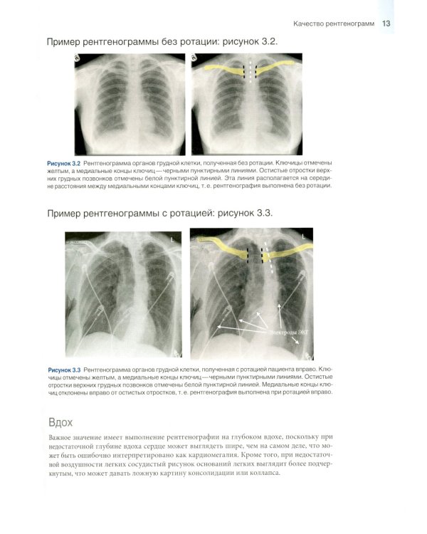 Основы рентгенографии органов грудной клетки
