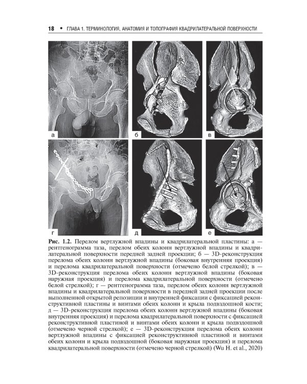 Хирургическое лечение переломов квадрилатеральной поверхности вертлужной впадины