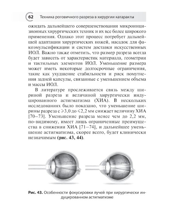 Техника роговичного разреза в хирургии катаракты