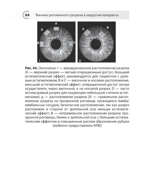 Техника роговичного разреза в хирургии катаракты