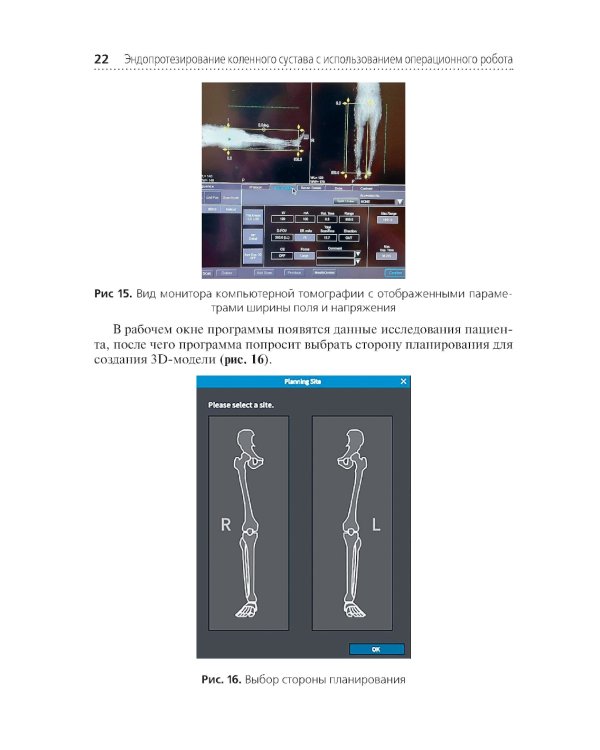 Эндопротезирование коленного сустава с использованием операционного робота: Учебное пособие
