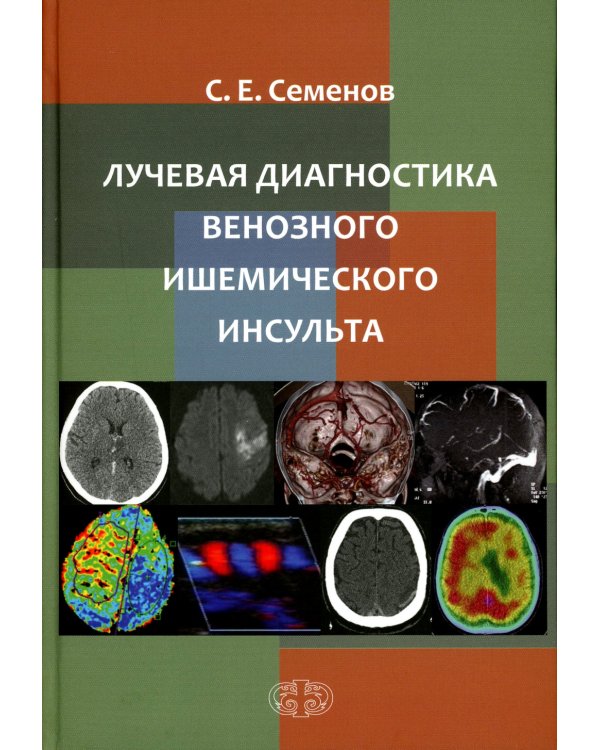 Лучевая диагностика венозного ишемического инсульта