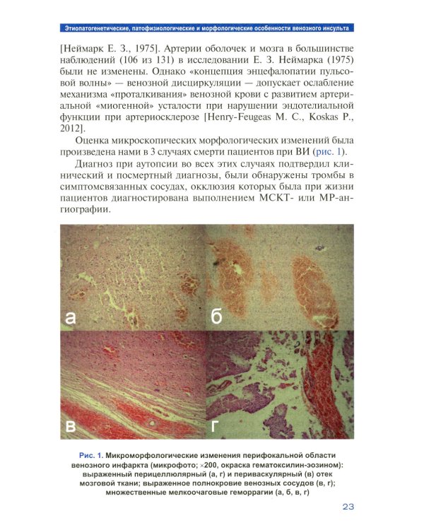 Лучевая диагностика венозного ишемического инсульта