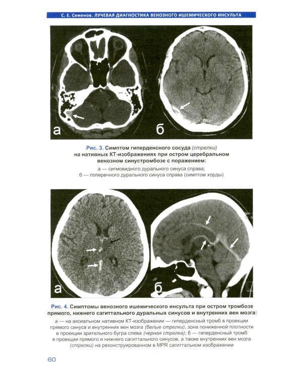 Лучевая диагностика венозного ишемического инсульта
