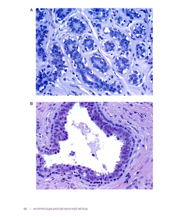 Интерпретация биопсий молочной железы