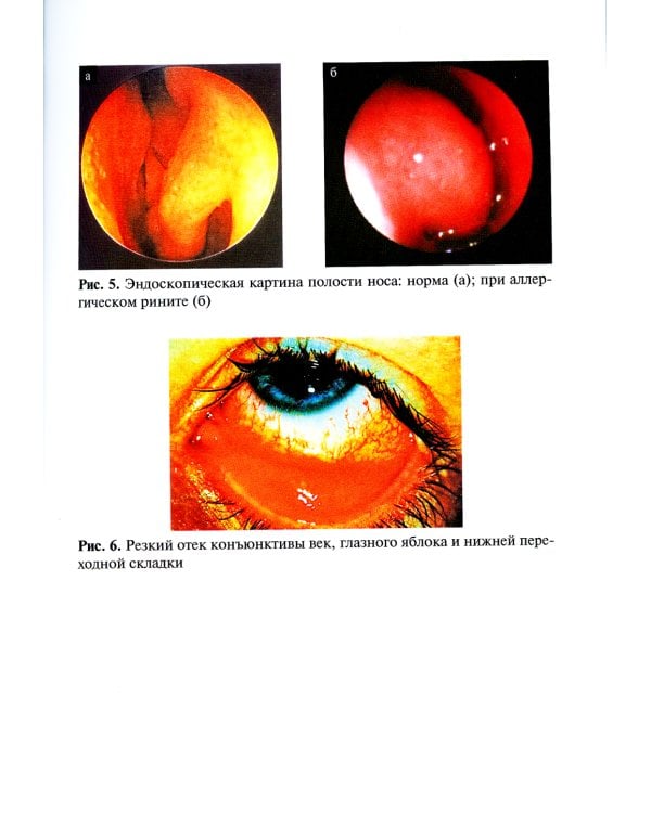 Аллергический риноконъюнктивит у детей