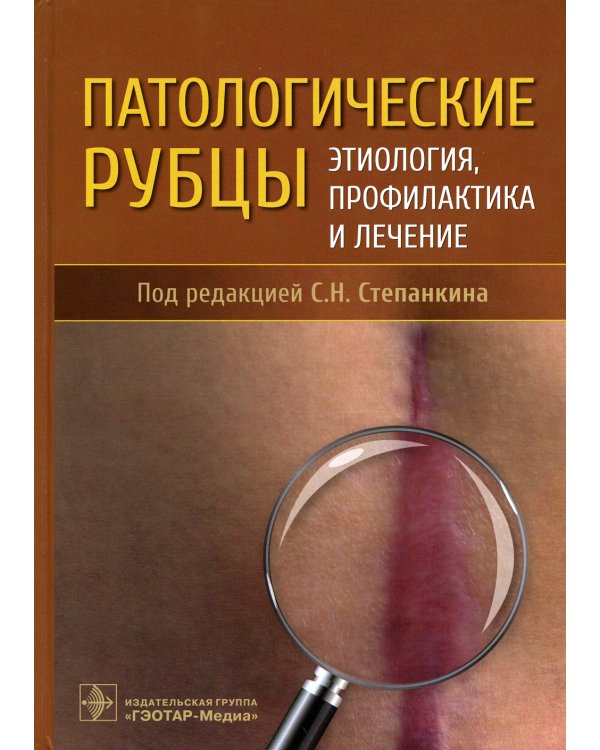 Патологические рубцы. Этиология, профилактика и лечение