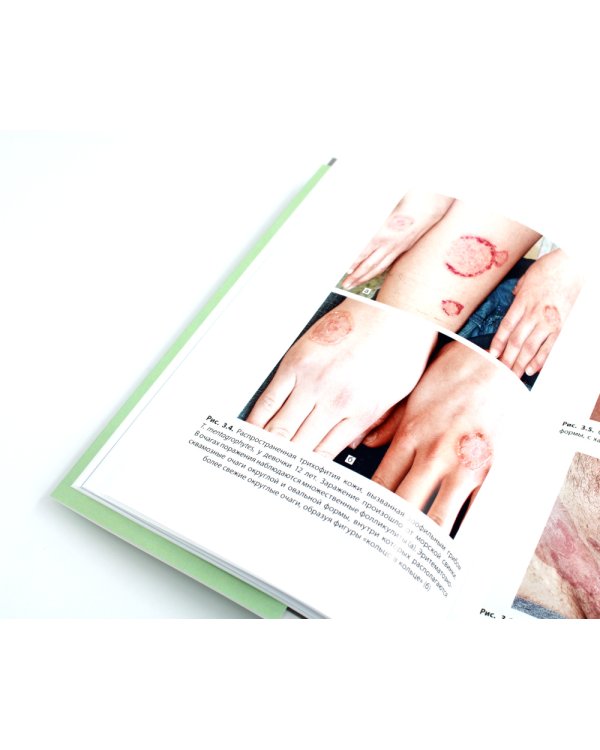 Инфекционные болезни кожи