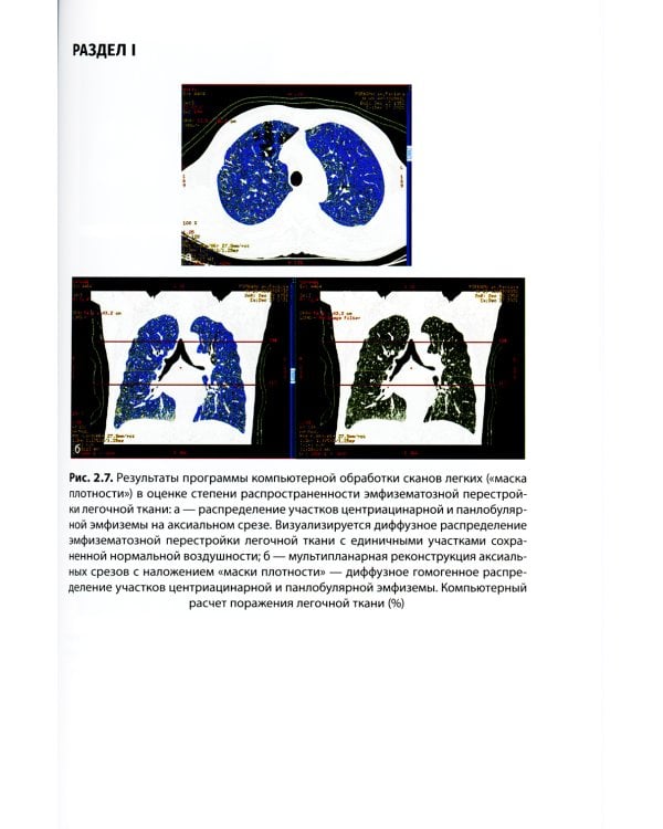 Хроническая обструктивная болезнь легких