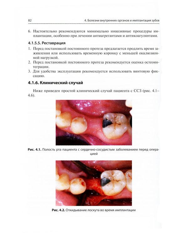 Дентальная имплантация у пациентов с медицинскими факторами риска