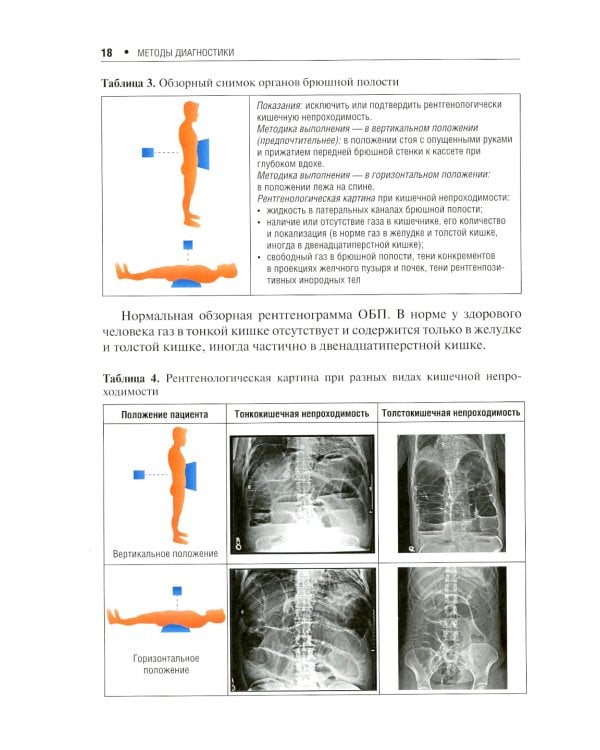 Острая кишечная непроходимость. Краткое руководство для врача-рентгенолога