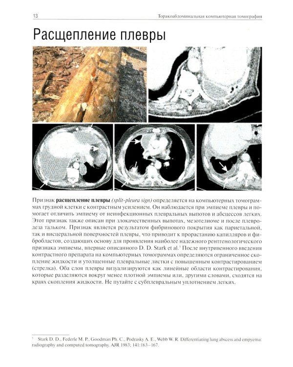 Торакоабдоминальная компьютерная томография. Образы и симптомы