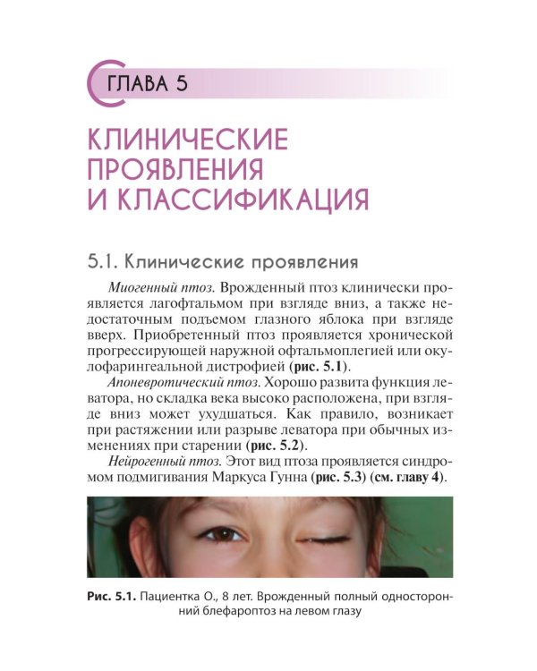 Блефароптоз