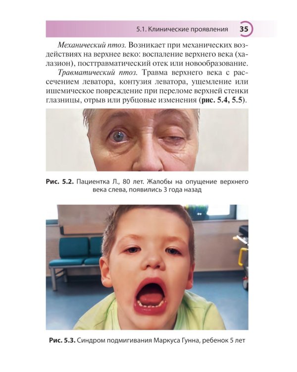 Блефароптоз