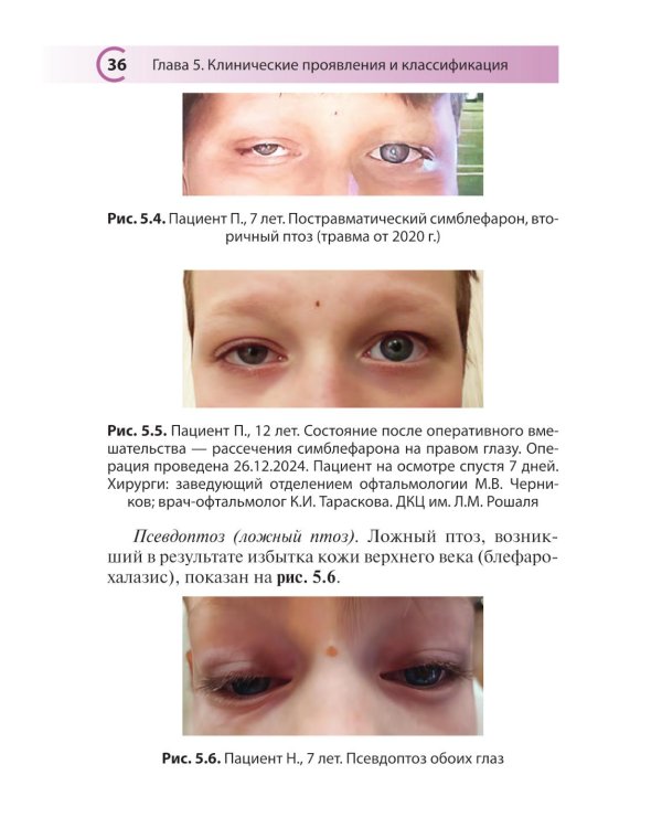 Блефароптоз