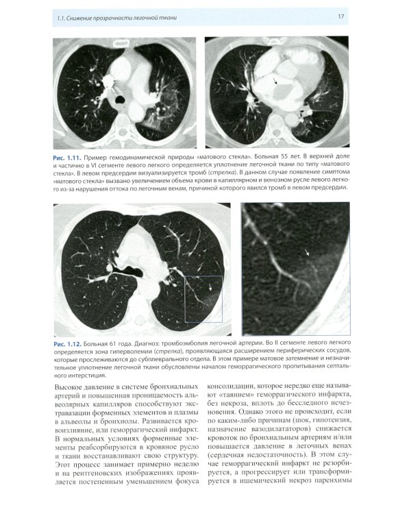 Компьютерная томография в пульмонологии. 4-е изд