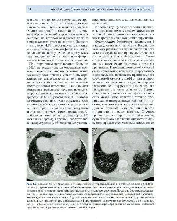 Компьютерная томография в пульмонологии. 4-е изд