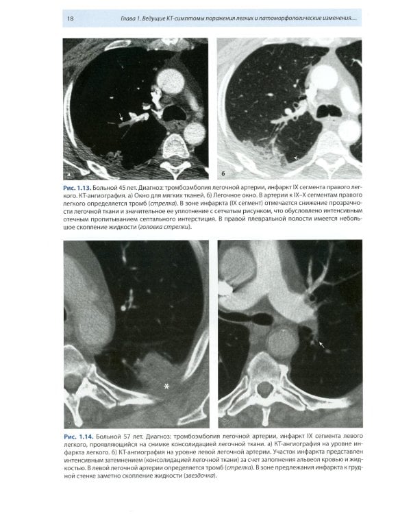 Компьютерная томография в пульмонологии. 4-е изд