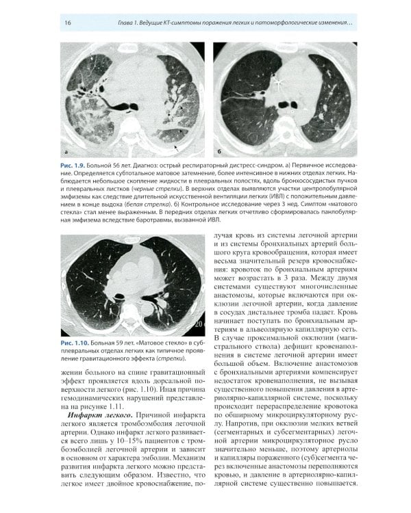Компьютерная томография в пульмонологии. 4-е изд