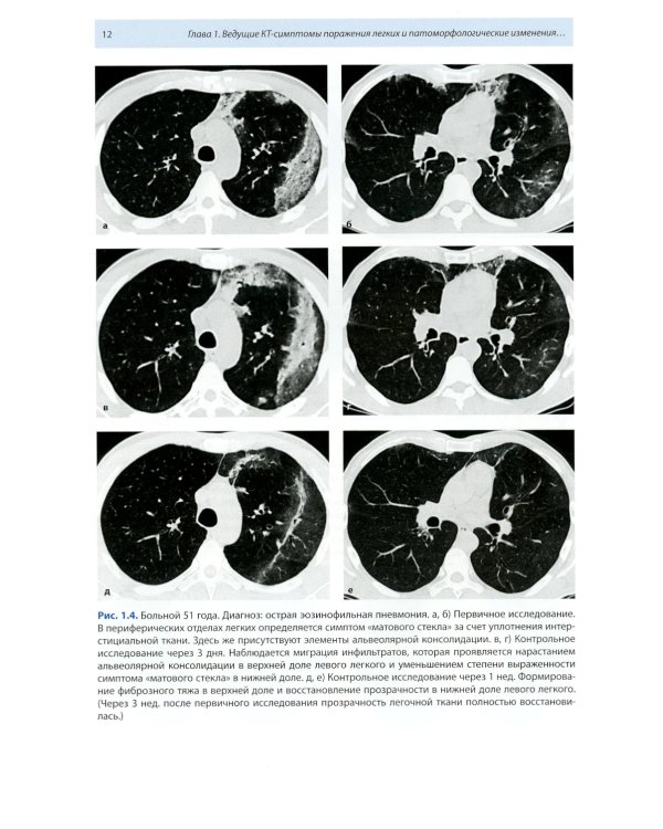 Компьютерная томография в пульмонологии. 4-е изд