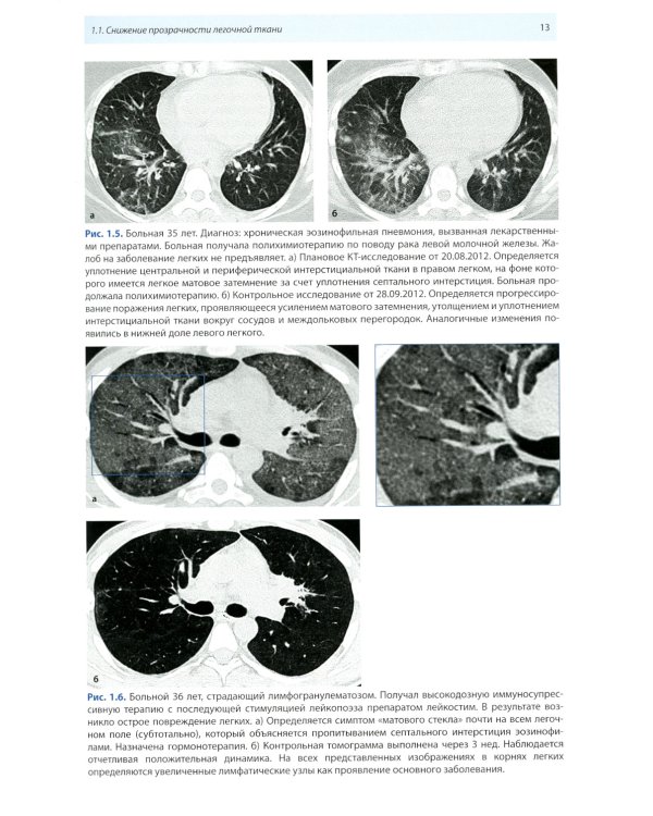 Компьютерная томография в пульмонологии. 4-е изд