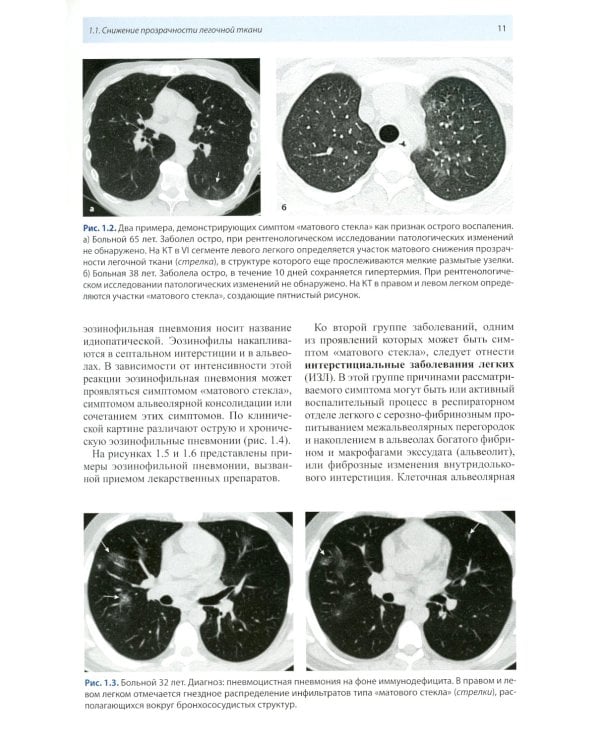 Компьютерная томография в пульмонологии. 4-е изд