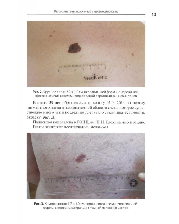 Диагностика ранней меланомы и предмеланомных образований кожи: Руководство - атлас для врачей первичного звена