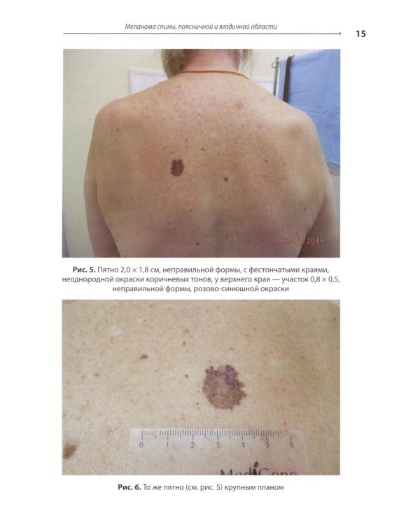 Диагностика ранней меланомы и предмеланомных образований кожи: Руководство - атлас для врачей первичного звена