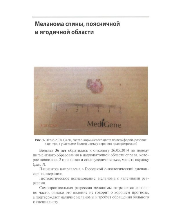 Диагностика ранней меланомы и предмеланомных образований кожи: Руководство - атлас для врачей первичного звена