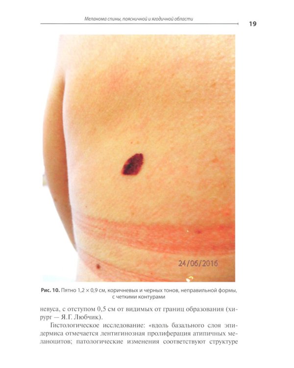 Диагностика ранней меланомы и предмеланомных образований кожи: Руководство - атлас для врачей первичного звена