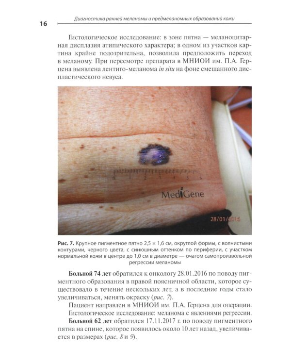 Диагностика ранней меланомы и предмеланомных образований кожи: Руководство - атлас для врачей первичного звена