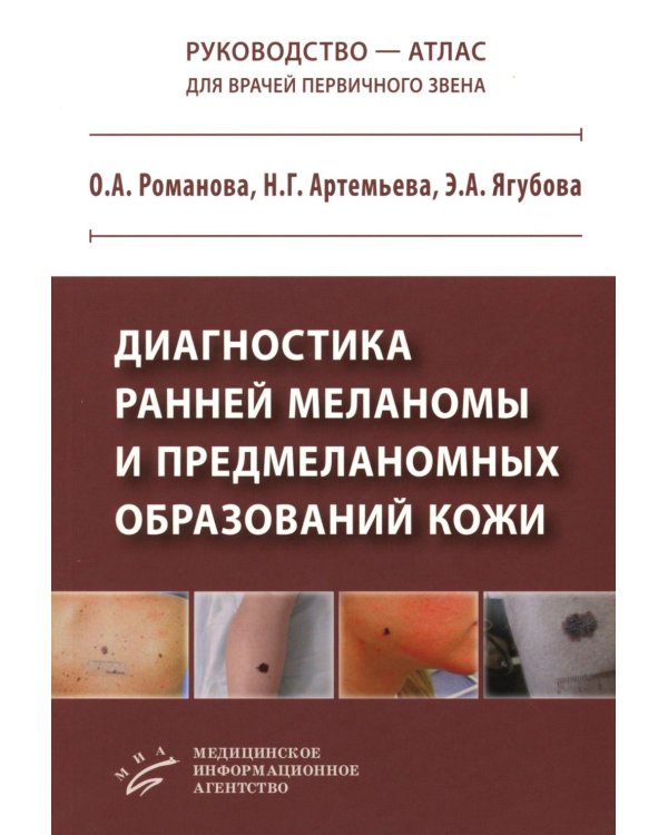 Диагностика ранней меланомы и предмеланомных образований кожи: Руководство - атлас для врачей первичного звена