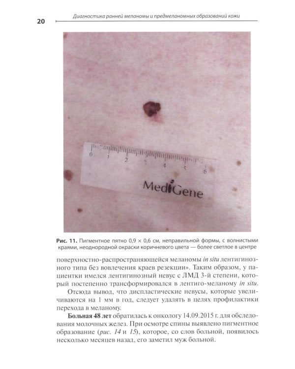 Диагностика ранней меланомы и предмеланомных образований кожи: Руководство - атлас для врачей первичного звена