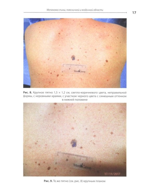 Диагностика ранней меланомы и предмеланомных образований кожи: Руководство - атлас для врачей первичного звена