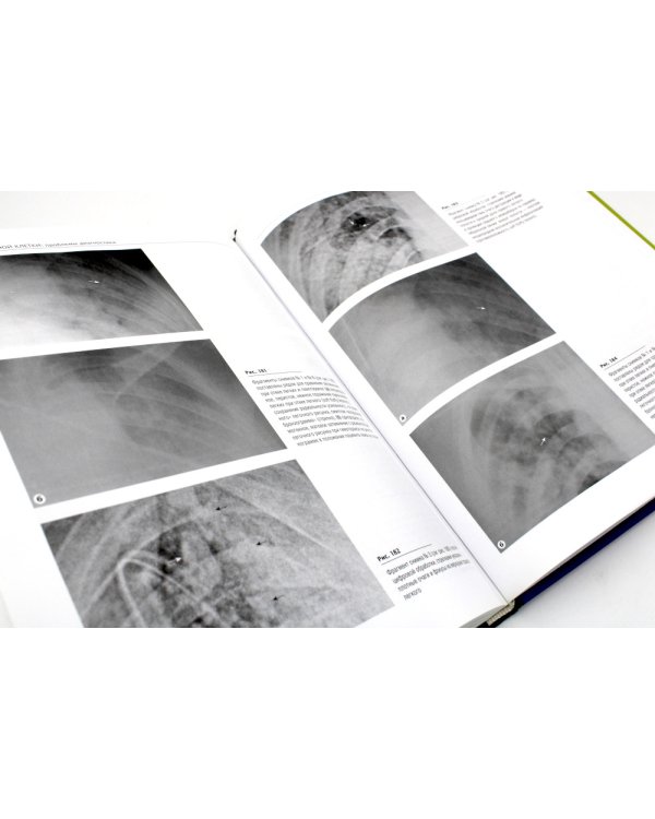 Закрытая травма грудной клетки: проблемы диагностики