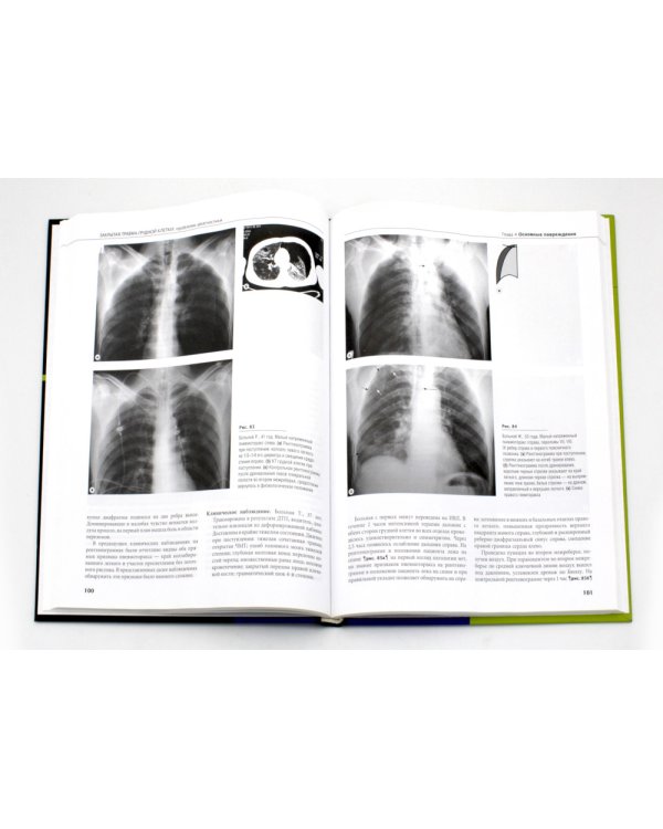 Закрытая травма грудной клетки: проблемы диагностики