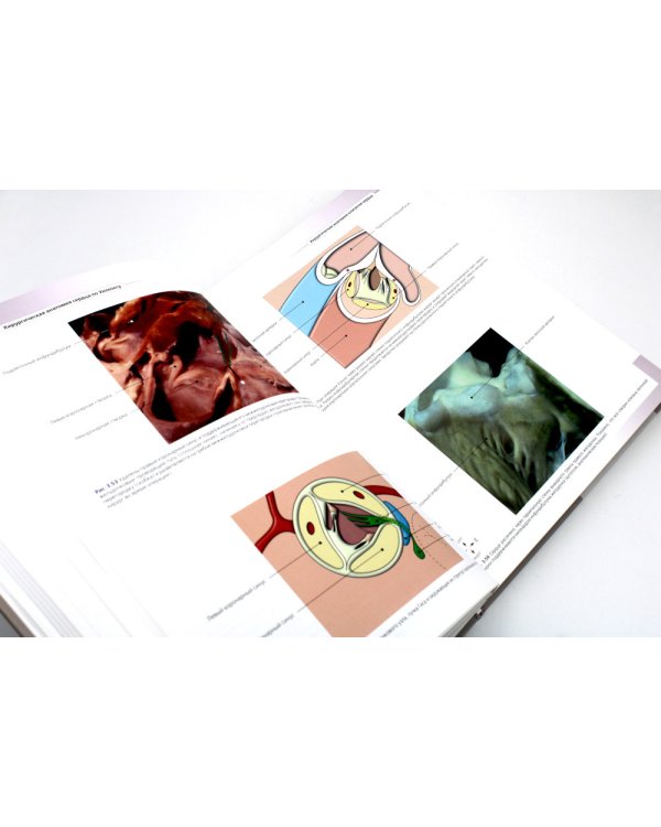 Хирургическая анатомия сердца по Уилкоксу