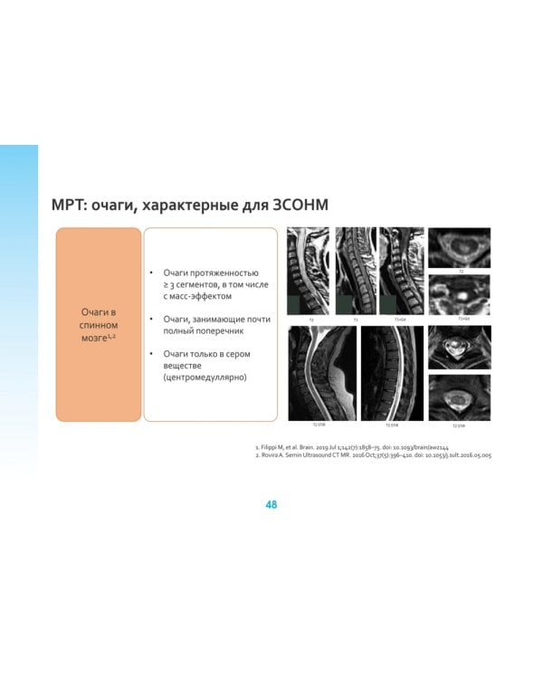 Оптиконевромиелит в фокусе. Практическое руководство в схемах и таблицах