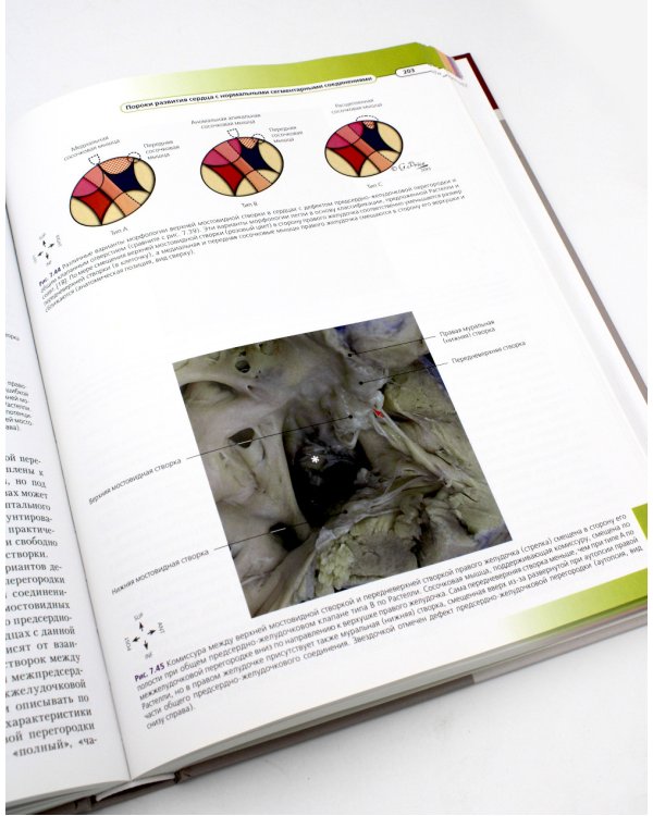 Хирургическая анатомия сердца по Уилкоксу