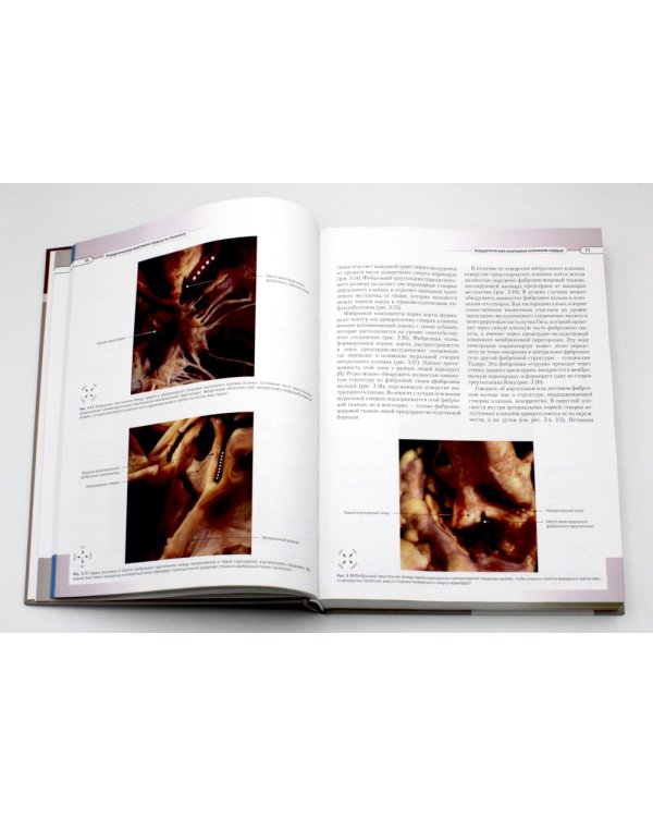 Хирургическая анатомия сердца по Уилкоксу